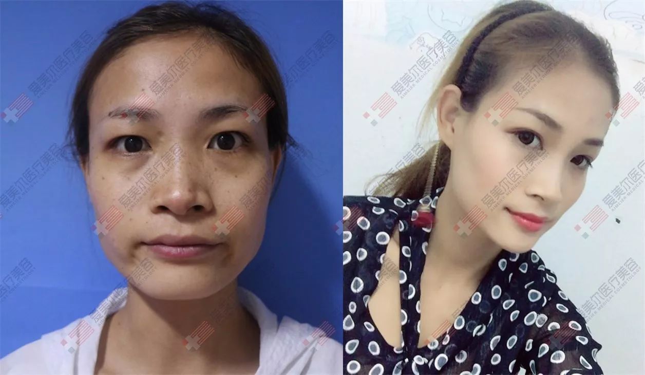 【爱美尔双11整形狂欢】全场低至11元起，1.1折美丽项目狂欢购!-爱喇叭网